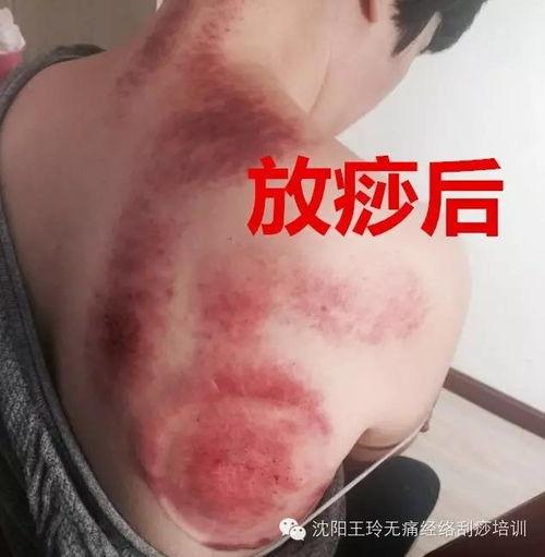 刮痧拔罐视频,健康生活新体验——揭秘刮痧拔罐神奇功效