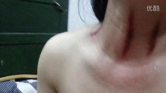 揪脖子痧视频